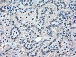 MAPK1 / ERK2 Antibody - IHC of paraffin-embedded Carcinoma of kidney tissue using anti-MAPK1 mouse monoclonal antibody. (Dilution 1:50).