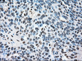 MAPK1 / ERK2 Antibody - IHC of paraffin-embedded Adenocarcinoma of ovary tissue using anti-MAPK1 mouse monoclonal antibody. (Dilution 1:50).