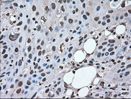 MAPK1 / ERK2 Antibody - IHC of paraffin-embedded Carcinoma of pancreas tissue using anti-MAPK1 mouse monoclonal antibody. (Dilution 1:50).