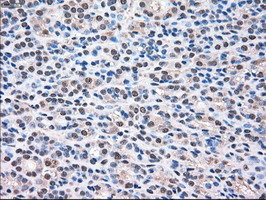MAPK1 / ERK2 Antibody - IHC of paraffin-embedded Carcinoma of thyroid tissue using anti-MAPK1 mouse monoclonal antibody. (Dilution 1:50).
