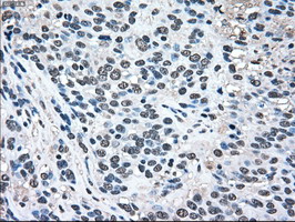 MAPK1 / ERK2 Antibody - IHC of paraffin-embedded Carcinoma of bladder tissue using anti-MAPK1 mouse monoclonal antibody. (Dilution 1:50).