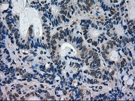 MAPK1 / ERK2 Antibody - IHC of paraffin-embedded Adenocarcinoma of colon tissue using anti-MAPK1 mouse monoclonal antibody. (Dilution 1:50).