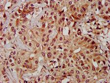 MAPK1 / ERK2 Antibody - Immunohistochemistry Dilution at 1:600 and staining in paraffin-embedded human liver cancer performed on a Leica BondTM system. After dewaxing and hydration, antigen retrieval was mediated by high pressure in a citrate buffer (pH 6.0). Section was blocked with 10% normal Goat serum 30min at RT. Then primary antibody (1% BSA) was incubated at 4°C overnight. The primary is detected by a biotinylated Secondary antibody and visualized using an HRP conjugated SP system.