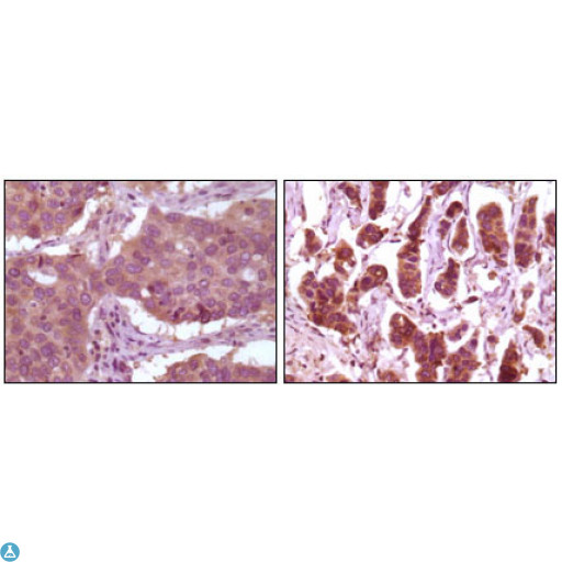 MAPK1 / ERK2 Antibody - Immunohistochemistry (IHC) analysis of paraffin-embedded Human Lung carcinoma (left) and breast carcinoma (right) showing cytoplasmic localization with DAB staining using ERK 2 Monoclonal Antibody.