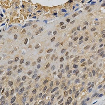 MAPK10 / JNK3 Antibody - Immunohistochemistry of paraffin-embedded human esophageal cancer tissue.