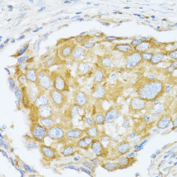 MAPK10 / JNK3 Antibody - Immunohistochemistry of paraffin-embedded human breast cancer tissue.