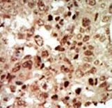MAPK11 / SAPK2 / p38 Beta Antibody - Formalin-fixed and paraffin-embedded human cancer tissue reacted with the primary antibody, which was peroxidase-conjugated to the secondary antibody, followed by AEC staining. This data demonstrates the use of this antibody for immunohistochemistry; clinical relevance has not been evaluated. BC = breast carcinoma; HC = hepatocarcinoma.