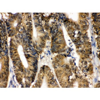 MAPK13 / p38delta Antibody - SAPK4 antibody IHC-paraffin. IHC(P): Human Intestinal Cancer Tissue.
