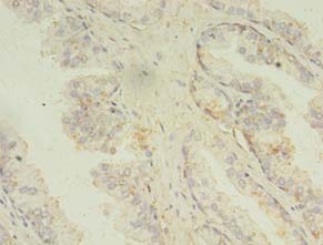 MAPK13 / p38delta Antibody - Immunohistochemistry of paraffin-embedded human prostate cancer using antibody at 1:100 dilution.