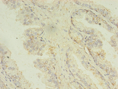 MAPK13 / p38delta Antibody - Immunohistochemistry of paraffin-embedded human prostate cancer using MAPK13 Antibody at dilution of 1:100