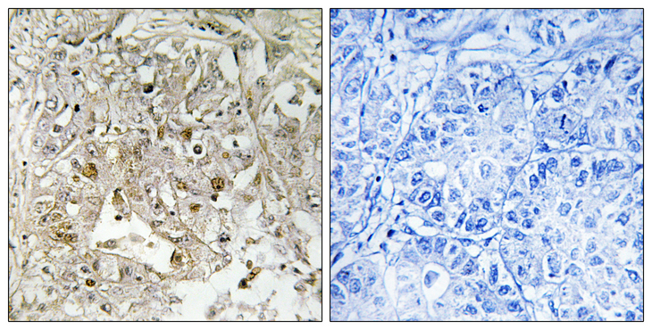 MAPK14 / p38 Antibody - Immunohistochemistry analysis of paraffin-embedded human liver carcinoma tissue, using p38 MAPK Antibody. The picture on the right is blocked with the synthesized peptide.