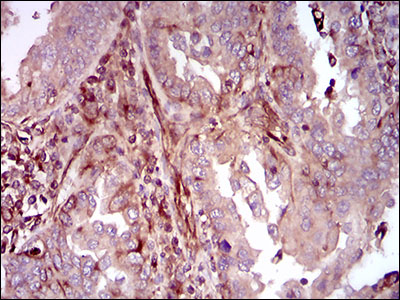 MAPK14 / p38 Antibody - IHC of paraffin-embedded endometrial cancer tissues using MAPK14 mouse monoclonal antibody with DAB staining.