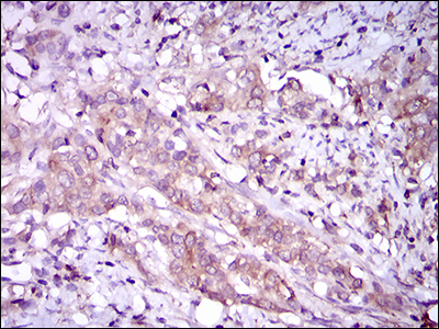 MAPK14 / p38 Antibody - IHC of paraffin-embedded cervical cancer tissues using MAPK14 mouse monoclonal antibody with DAB staining.