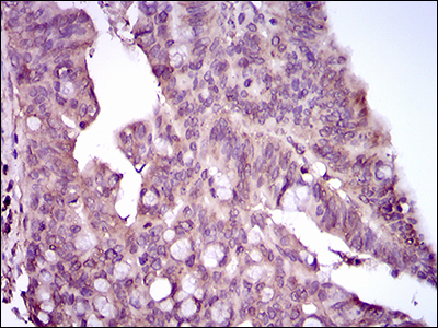MAPK14 / p38 Antibody - IHC of paraffin-embedded rectum cancer tissues using MAPK14 mouse monoclonal antibody with DAB staining.