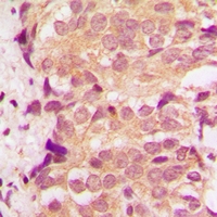 MAPK14 / p38 Antibody - Immunohistochemical analysis of p38 staining in human breast cancer formalin fixed paraffin embedded tissue section. The section was pre-treated using heat mediated antigen retrieval with sodium citrate buffer (pH 6.0). The section was then incubated with the antibody at room temperature and detected with HRP and DAB as chromogen. The section was then counterstained with hematoxylin and mounted with DPX.