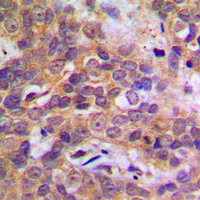 MAPK14 / p38 Antibody - Immunohistochemical analysis of p38 staining in human breast cancer formalin fixed paraffin embedded tissue section. The section was pre-treated using heat mediated antigen retrieval with sodium citrate buffer (pH 6.0). The section was then incubated with the antibody at room temperature and detected using an HRP conjugated compact polymer system. DAB was used as the chromogen. The section was then counterstained with hematoxylin and mounted with DPX.