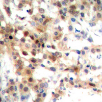 MAPK14 / p38 Antibody - Immunohistochemical analysis of p38 staining in human breast cancer formalin fixed paraffin embedded tissue section. The section was pre-treated using heat mediated antigen retrieval with sodium citrate buffer (pH 6.0). The section was then incubated with the antibody at room temperature and detected using an HRP conjugated compact polymer system. DAB was used as the chromogen. The section was then counterstained with hematoxylin and mounted with DPX.