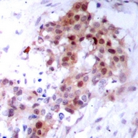 MAPK14 / p38 Antibody - Immunohistochemical analysis of p38 staining in human breast cancer formalin fixed paraffin embedded tissue section. The section was pre-treated using heat mediated antigen retrieval with sodium citrate buffer (pH 6.0). The section was then incubated with the antibody at room temperature and detected using an HRP polymer system. DAB was used as the chromogen. The section was then counterstained with hematoxylin and mounted with DPX.