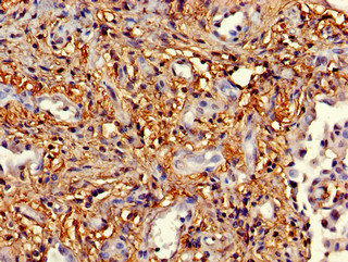MAPK14 / p38 Antibody - Immunohistochemistry of paraffin-embedded human lung cancer using MAPK14 Antibody at dilution of 1:100