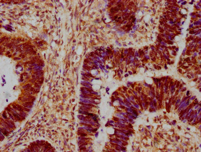MAPK14 / p38 Antibody - IHC image of MAPK14 Antibody diluted at 1:300 and staining in paraffin-embedded human ovarian cancer performed on a Leica BondTM system. After dewaxing and hydration, antigen retrieval was mediated by high pressure in a citrate buffer (pH 6.0). Section was blocked with 10% normal goat serum 30min at RT. Then primary antibody (1% BSA) was incubated at 4°C overnight. The primary is detected by a biotinylated secondary antibody and visualized using an HRP conjugated SP system.