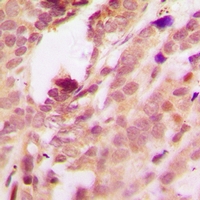 MAPK14 / p38 Antibody - Immunohistochemical analysis of p38 (pT180/Y182) staining in human breast cancer formalin fixed paraffin embedded tissue section. The section was pre-treated using heat mediated antigen retrieval with sodium citrate buffer (pH 6.0). The section was then incubated with the antibody at room temperature and detected with HRP and DAB as chromogen. The section was then counterstained with hematoxylin and mounted with DPX.