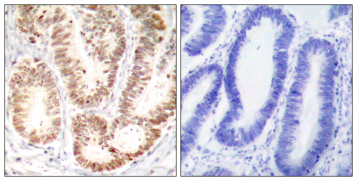 MAPK14 / p38 Antibody - Immunohistochemistry analysis of paraffin-embedded human colon carcinoma, using p38 MAPK (Phospho-Tyr182) Antibody. The picture on the right is blocked with the phospho peptide.