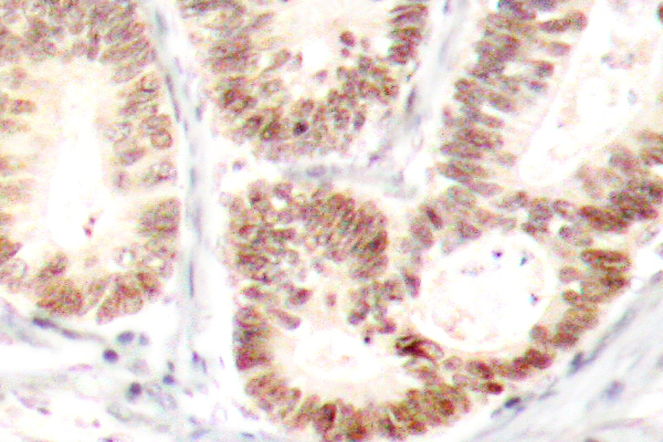 MAPK14 / p38 Antibody - IHC of p-p38 (Y182) pAb in paraffin-embedded human colon carcinoma tissue.