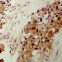 MAPK14 / p38 Antibody - Immunohistochemical analysis of p38 (pY182) staining in human breast cancer formalin fixed paraffin embedded tissue section. The section was pre-treated using heat mediated antigen retrieval with sodium citrate buffer (pH 6.0). The section was then incubated with the antibody at room temperature and detected using an HRP polymer system. DAB was used as the chromogen. The section was then counterstained with hematoxylin and mounted with DPX.