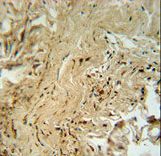 MAPK14 / p38 Antibody - MAPK14 Antibody (T180/Y182)immunohistochemistry of formalin-fixed and paraffin-embedded human lung carcinoma followed by peroxidase-conjugated secondary antibody and DAB staining. This data demonstrates the use of the MAPK14 Antibody (T180/Y182) for immunohistochemistry.