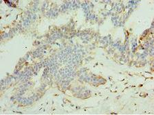 MAPK15 / ERK7 Antibody - Immunohistochemistry of paraffin-embedded human breast cancer using antibody at 1:100 dilution.