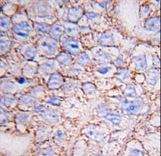 MAPK15 / ERK7 Antibody - Formalin-fixed and paraffin-embedded human breast carcinoma tissue reacted with ERK8 antibody , which was peroxidase-conjugated to the secondary antibody, followed by DAB staining. This data demonstrates the use of this antibody for immunohistochemistry; clinical relevance has not been evaluated.