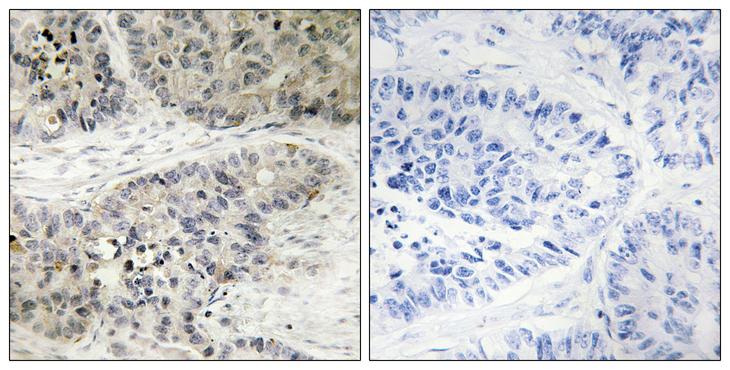 MAPK15 / ERK7 Antibody - Peptide - + Immunohistochemistry analysis of paraffin-embedded human lung carcinoma tissue, using MAPK15 antibody.