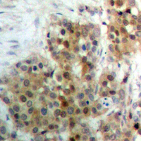 MAPK15 / ERK7 Antibody - Immunohistochemical analysis of ERK7 (pT175/Y177) staining in human breast cancer formalin fixed paraffin embedded tissue section. The section was pre-treated using heat mediated antigen retrieval with sodium citrate buffer (pH 6.0). The section was then incubated with the antibody at room temperature and detected using an HRP conjugated compact polymer system. DAB was used as the chromogen. The section was then counterstained with hematoxylin and mounted with DPX.
