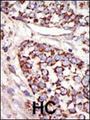 MAPK3 / ERK1 Antibody - Formalin-fixed and paraffin-embedded human cancer tissue reacted with the primary antibody, which was peroxidase-conjugated to the secondary antibody, followed by DAB staining. This data demonstrates the use of this antibody for immunohistochemistry; clinical relevance has not been evaluated. BC = breast carcinoma; HC = hepatocarcinoma.