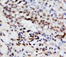 MAPK3 / ERK1 Antibody - IHC-P: ERK1 antibody testing of human breast cancer tissue