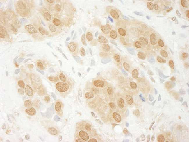 MAPK3 / ERK1 Antibody - Detection of Human ERK1 by Immunohistochemistry. Sample: FFPE section of human breast carcinoma. Antibody: Affinity purified rabbit anti-ERK1 used at a dilution of 1:200 (1 Detection: DAB.