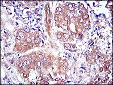 MAPK3 / ERK1 Antibody - IHC of paraffin-embedded breast cancer tissues using MAPK3 mouse monoclonal antibody with DAB staining.