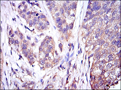 MAPK3 / ERK1 Antibody - IHC of paraffin-embedded bladder cancer tissues using MAPK3 mouse monoclonal antibody with DAB staining.