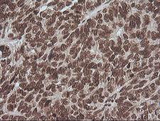 MAPK3 / ERK1 Antibody - IHC of paraffin-embedded Adenocarcinoma of Human ovary tissue using anti-MAPK3 mouse monoclonal antibody. (Heat-induced epitope retrieval by 10mM citric buffer, pH6.0, 100C for 10min).