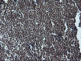 MAPK3 / ERK1 Antibody - IHC of paraffin-embedded Human lymphoma tissue using anti-MAPK3 mouse monoclonal antibody. (Heat-induced epitope retrieval by 10mM citric buffer, pH6.0, 100C for 10min).