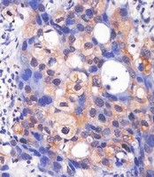 MAPK3 / ERK1 Antibody - MAPK3/1 Antibody (Center) staining MAPK3/1 in human breast carcinoma sections by Immunohistochemistry (IHC-P - paraformaldehyde-fixed, paraffin-embedded sections). Tissue was fixed with formaldehyde and blocked with 3% BSA for 0. 5 hour at room temperature; antigen retrieval was by heat mediation with a citrate buffer (pH6). Samples were incubated with primary antibody (1/25) for 1 hours at 37°C. A undiluted biotinylated goat polyvalent antibody was used as the secondary antibody.