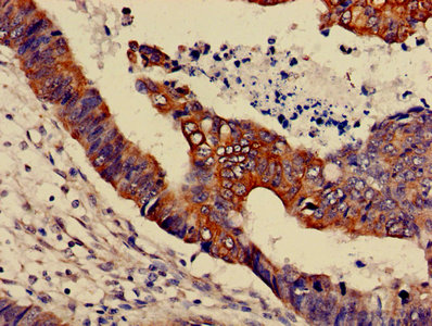 MAPK3 / ERK1 Antibody - IHC image of MAPK3 Antibody diluted at 1:600 and staining in paraffin-embedded human colon cancer performed on a Leica BondTM system. After dewaxing and hydration, antigen retrieval was mediated by high pressure in a citrate buffer (pH 6.0). Section was blocked with 10% normal goat serum 30min at RT. Then primary antibody (1% BSA) was incubated at 4°C overnight. The primary is detected by a biotinylated secondary antibody and visualized using an HRP conjugated SP system.