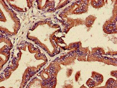 MAPK3 / ERK1 Antibody - IHC image of MAPK3 Antibody diluted at 1:600 and staining in paraffin-embedded human prostate cancer performed on a Leica BondTM system. After dewaxing and hydration, antigen retrieval was mediated by high pressure in a citrate buffer (pH 6.0). Section was blocked with 10% normal goat serum 30min at RT. Then primary antibody (1% BSA) was incubated at 4°C overnight. The primary is detected by a biotinylated secondary antibody and visualized using an HRP conjugated SP system.