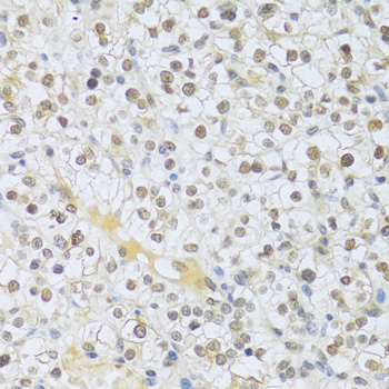 MAPK3 / ERK1 Antibody - Immunohistochemistry of paraffin-embedded human kidney cancer using MAPK3 Antibodyat dilution of 1:100 (40x lens).