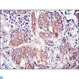 MAPK3 / ERK1 Antibody - Immunohistochemistry (IHC) analysis of paraffin-embedded breast cancer tissues with DAB staining using ERK 1 Monoclonal Antibody.