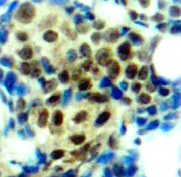 MAPK3 / ERK1 Antibody - Immunohistochemical analysis of paraffin-embedded human breast carcinoma tissue.