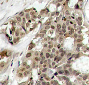 MAPK3 / ERK1 Antibody - Immunohistochemical analysis of paraffin-embedded human breast carcinoma tissue.