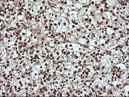 MAPK4 / ERK4 Antibody - IHC of paraffin-embedded Carcinoma of Human kidney tissue using anti-MAPK4 mouse monoclonal antibody.