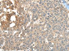 MAPK4 / ERK4 Antibody - Immunohistochemistry of paraffin-embedded Human liver cancer tissue  using MAPK4 Polyclonal Antibody at dilution of 1:35(×200)