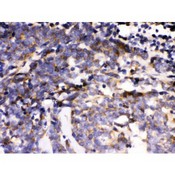 MAPK6 / ERK3 Antibody - MAPK6 antibody IHC-paraffin. IHC(P): Human Lung Cancer Tissue.